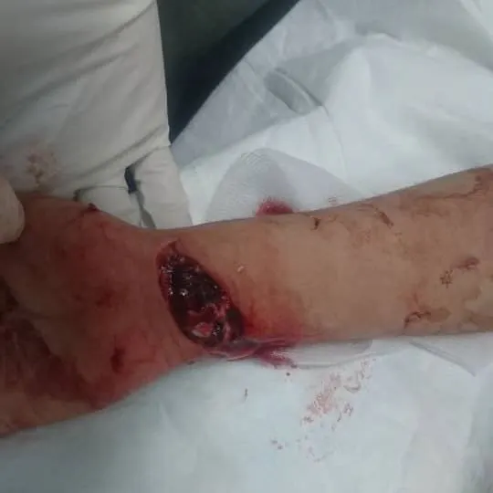 تسببت فيها كأس مكسورة.. مركزي القطيف يعالج قطع 10 أوتار وعصبين لطفل
