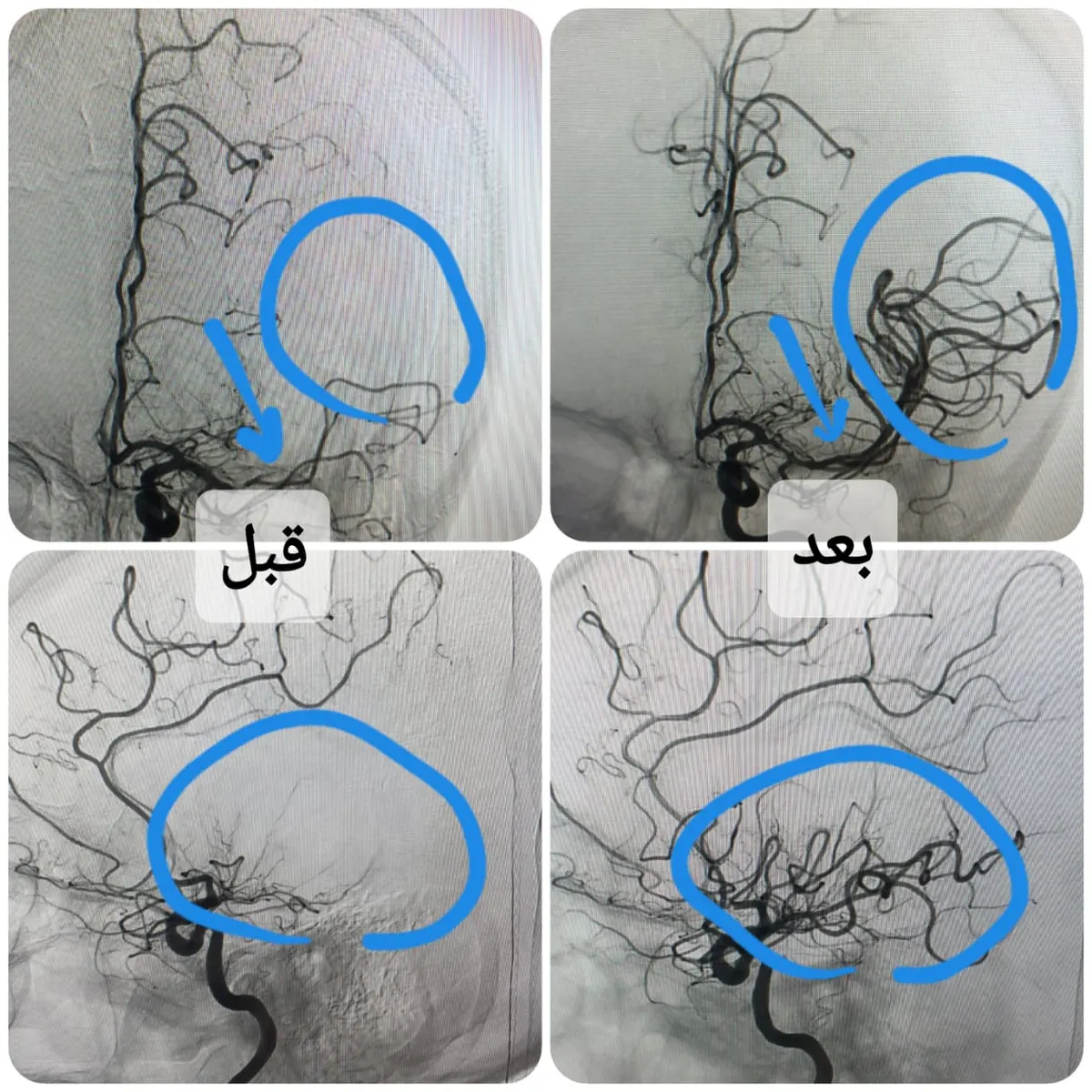 في مستشفى المواساة.. سحب جلطة دماغية ينقذ مريضًا من الشلل النصفي
