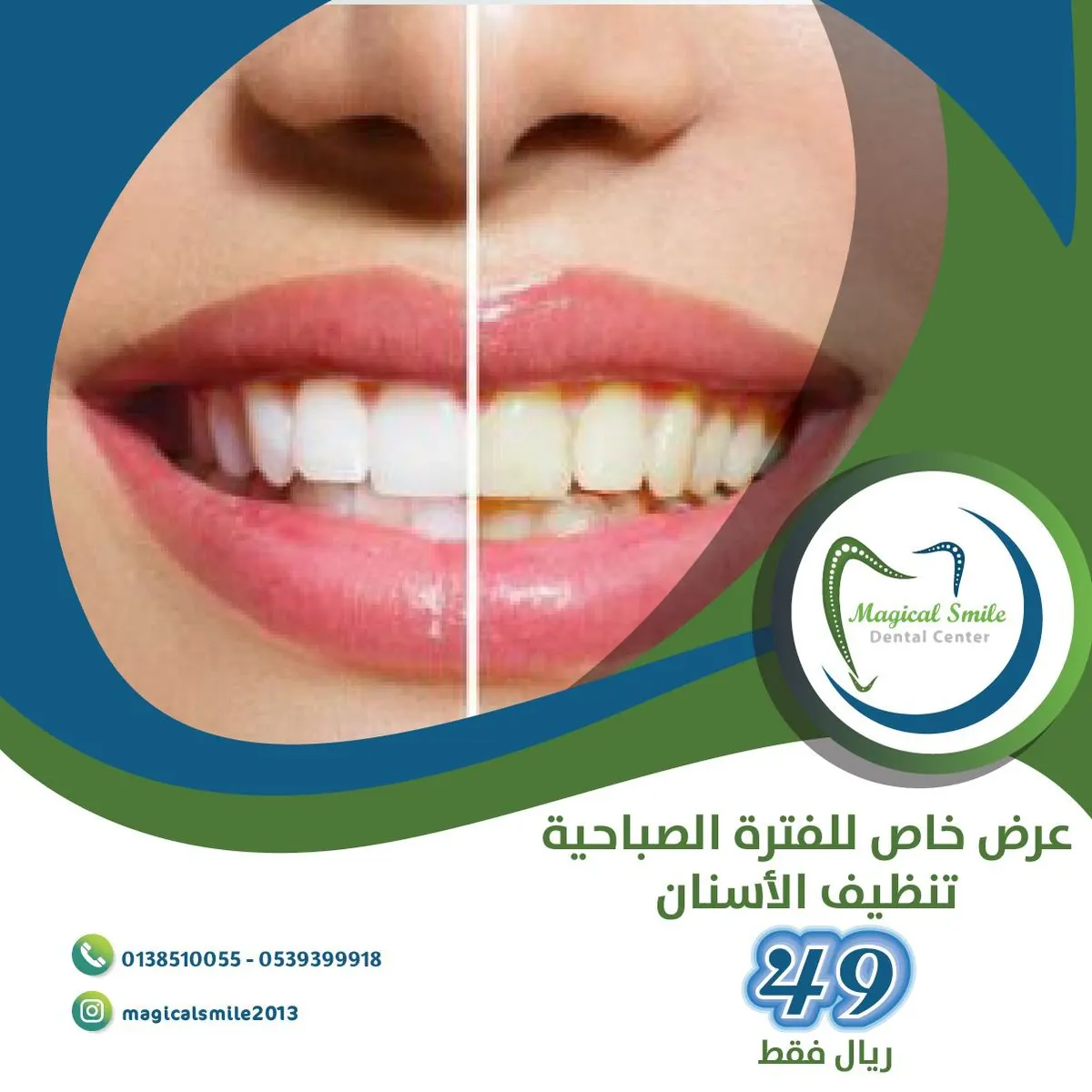 تنظيف وتلميع الأسنان بـ 49 ريال في القطيف