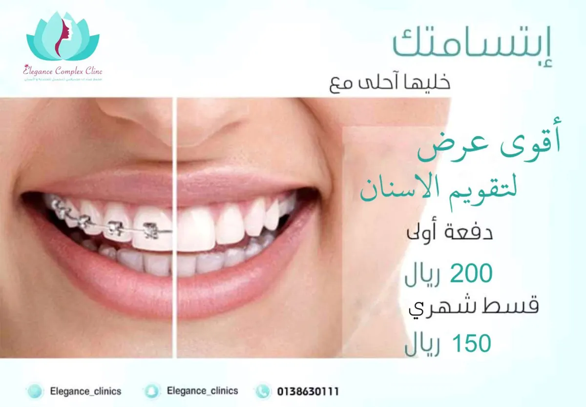 الآن في عيادات إيليجنس تقويم الأسنان بـ150 ريالاً فقط.. الحق العرض