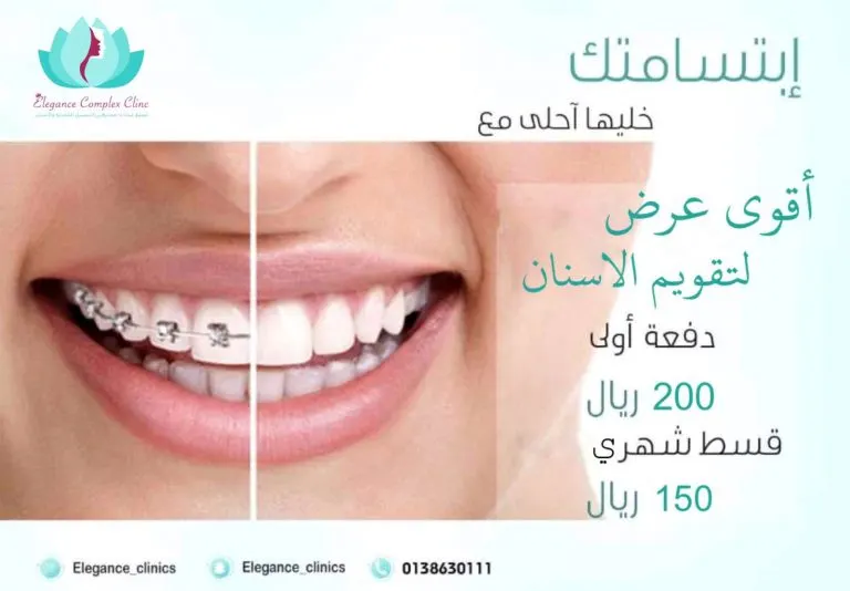 الآن في عيادات إيليجنس تقويم الأسنان بـ150 ريالاً فقط.. الحق العرض