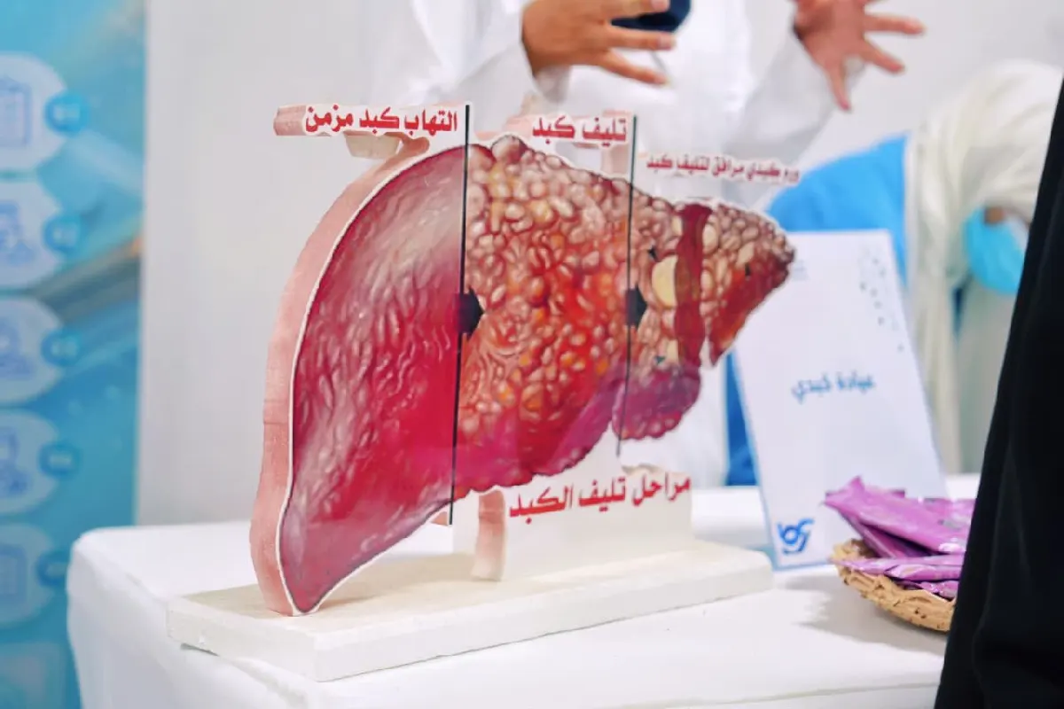من السليم إلى التليف والمزمن.. «القطيف المركزي» يواجه التهاب الكبد الفيروسي بالفحص والتوعية
