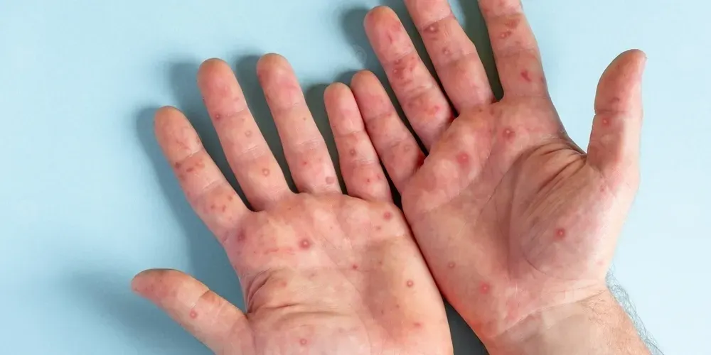 وقاية: لم يتم رصد فيروس جدري القرود Mpox النمط الأول المتسبب بإعلان الطارئة الصحية عالمياً بالمملكة حتى الآن