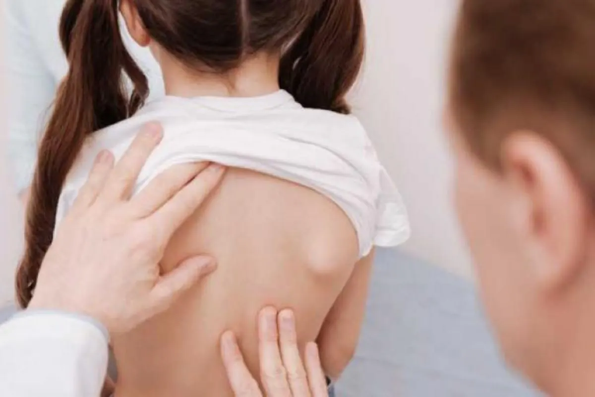 مختص: خجل الفتيات وراء ظهور «حدبة الظهر».. و5 طرق للوقاية