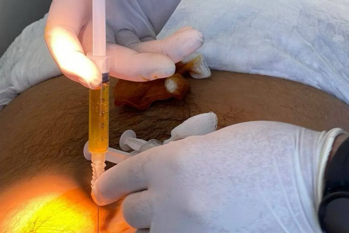 هل ستصبح حقن PRP العلاج المفضل لآلام الظهر؟
