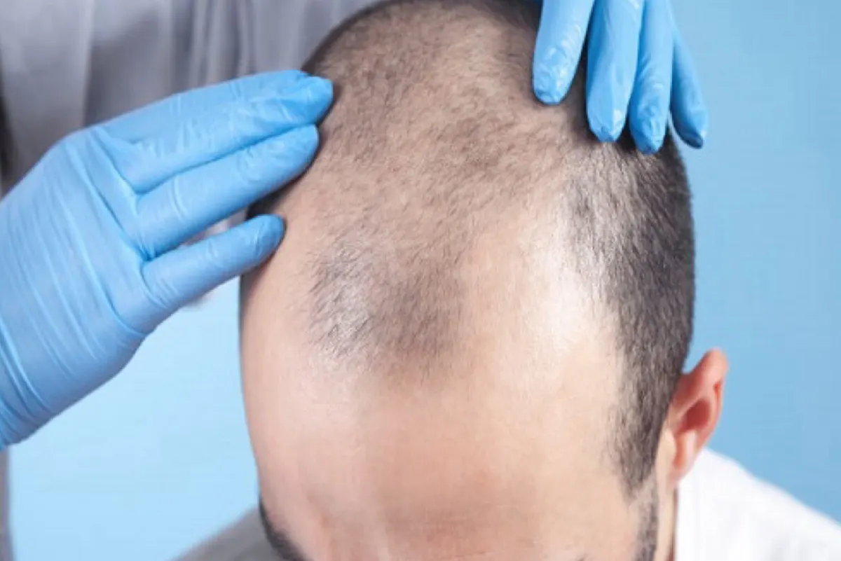 100 ألف ريال والسجن 6 أشهر.. عقوبات لمخالفي اشتراطات زراعة الشعر