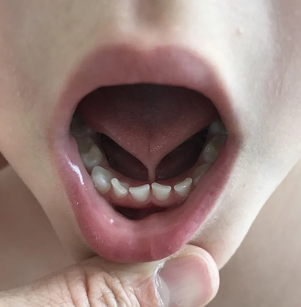 ما ينبغي معرفة عن التصاق اللسان Tongue-Tie