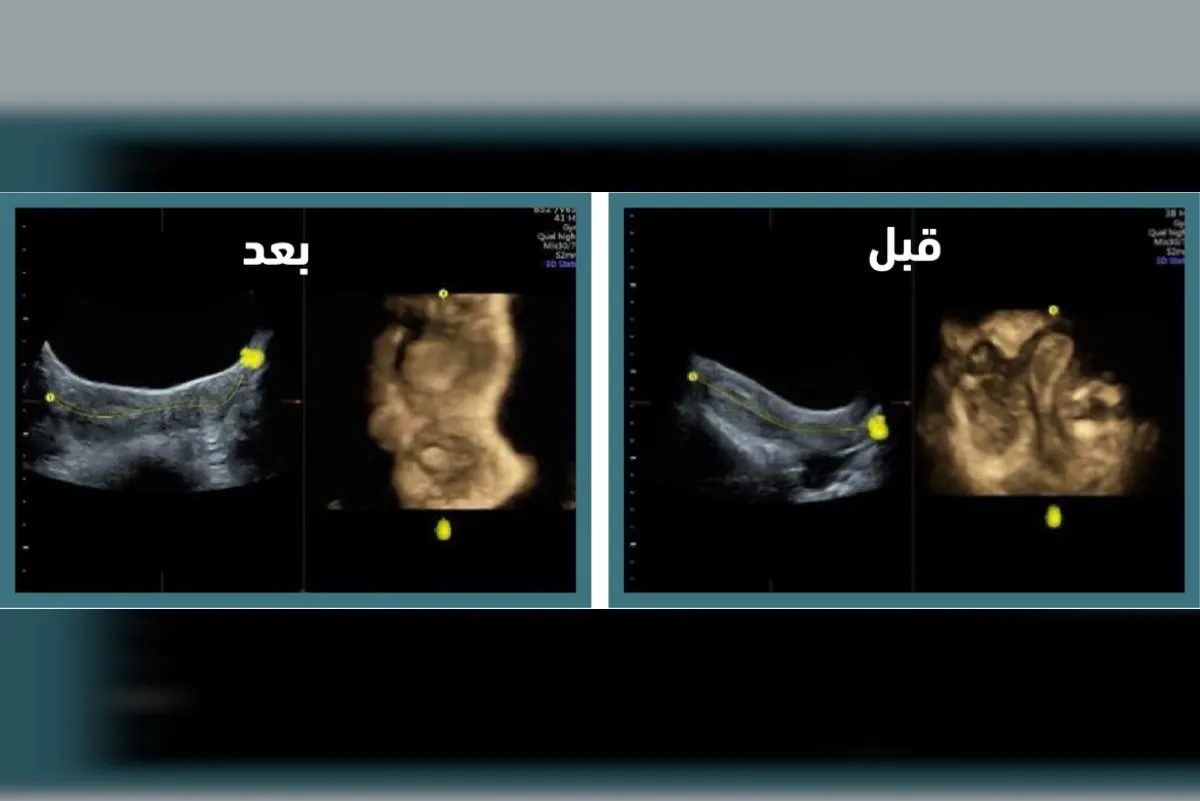 ”رحم وحيد القرن“.. جراحة تُنهي معاناة فتاة من تشوه نادر