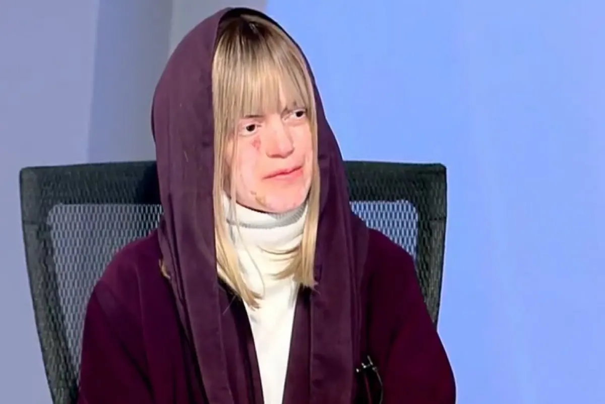 أبرار آل عثمان: مرض جلدي لا يمنعني من الدراسة.. لكن تصرفات زميلاتي تؤلمني