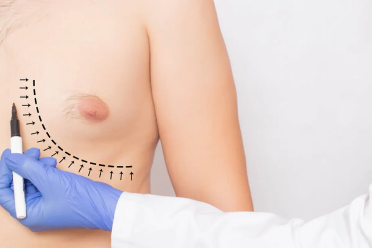 هل كل تضخم في ثدي الرجل يعتبر تثدياً حقيقياً؟ استشاري تجميل يجيب