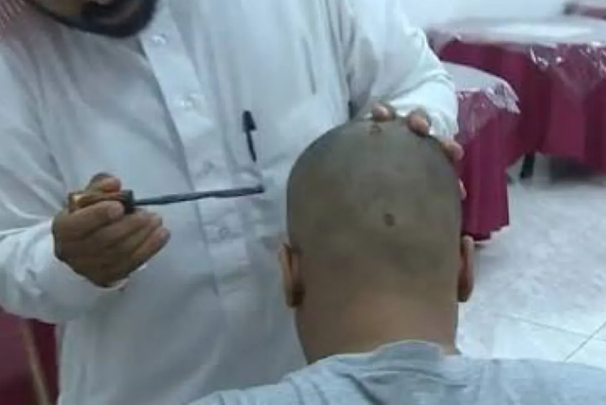 استشاري يحذر: كي الرأس بالنار ليس علاجاً لجلطات الدماغ