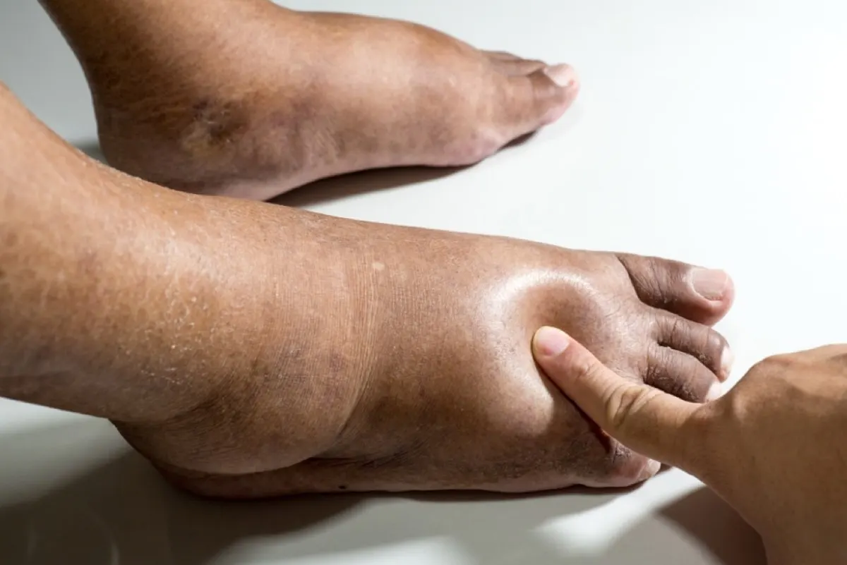 استشاري كلى يحذر: احتباس السوائل عرض خطير يتطلب فريقاً طبياً متكاملاً