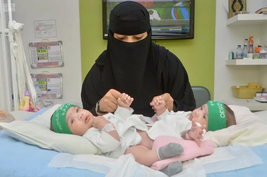 8 مراحل لفصل التوأم السيامي “شيخة وشموخ”.. ووضعهما الصحي مستقر