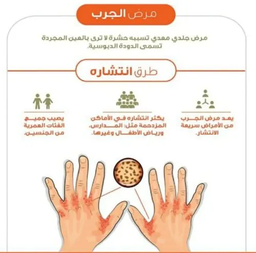 لا حالات جديدة خلال أسبوعين.. السيطرة على ظهور “محدود” لـ”الجرب” في تاروت