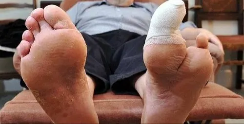 غفلة جرح بسيط تنتهي بفقد أصابع السيهاتي