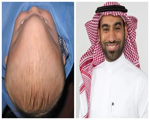 أول إنجاز من نوعه مركزي القطيف: إعادة تشكيل جمجمة رضيع باستخدام المنظار
