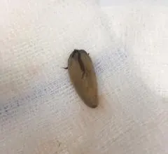 بعد الأمعاء والقلب.. إنقاذ طفل من حبة مكسرات
