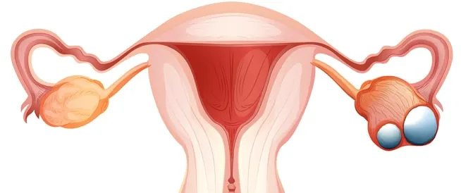 عملية معقدة.. 90 دقيقة لاستئصال ورم من مبيض مريضة حامل