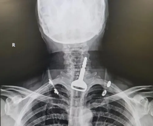 حدث في القنفذة.. إخراج مفتاح “ددسن” من حنجرة سائق