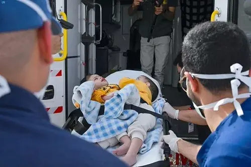 إنفاذاً لتوجيهات القيادة.. فصل التوأم السيامي “بسام وإحسان” غداً