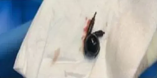 مكة.. 4 ساعات لاستخراج قطعة مغناطيسية من أمعاء مريض