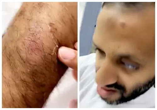 سيهات.. معلم كفيف يتهم سائقه بضربه و عضه أمام أسرته