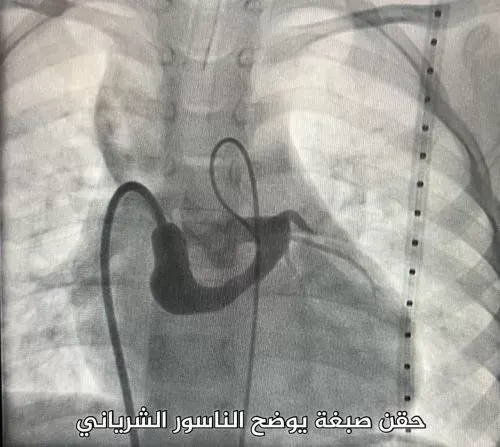 القصيم.. قسطرة قلبية لإنقاذ طفل من ناسور شرياني