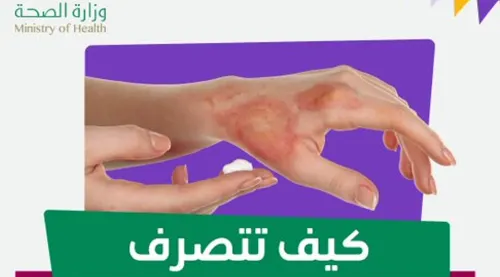 “عيش بصحة” تقدم 4 نصائح للتغلب على حروق الجلد