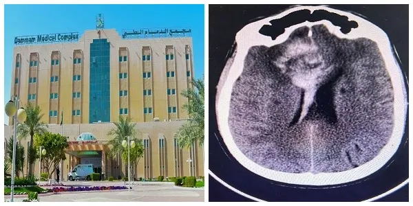 الدمام.. قسطرة متطورة أنقذت مواطناً من شلل نصفي