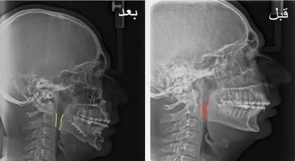 مشكلة في الفكّين عذّبت أربعينياً باضطرابات النوم