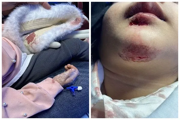 أُصيب وابنتاه بحادث دعس.. حبيب درويش يطالب بمراقبة السرعة في كورنيش الرامس