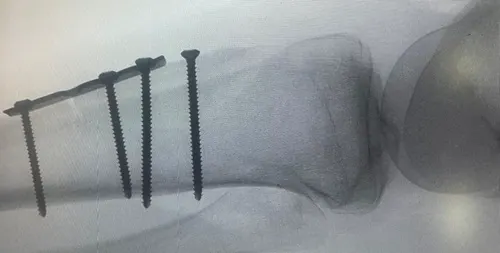 الدمام.. تدخل جراحي نادر لإيقاف خلع متكرر في الركبة