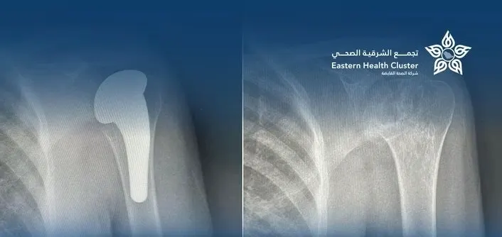 مجمع الدمام.. تبديل جزئي لمفصل الكتف يعيد الحركة لمريضة