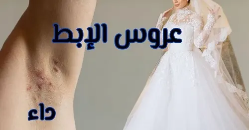 بثرة الإبط.. “حبة العروس” لا يحبها أحد.. ودواؤها من غرف النوم..!