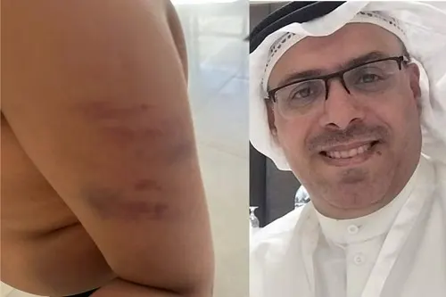 كاميرات معطلة وكدمات غامضة.. القلاف لـ صُبرة”: “الموارد البشرية” تحقق في قضية تعنيف ابن أختي “أمير”