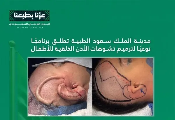 “سعود الطبية”.. برنامج نوعي يرمّم تشوّهاً خلقياً بأذن طفل